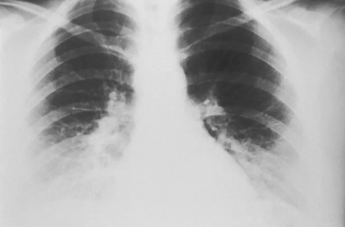 Radiografia de tórax em incidência frontal mostrando pulmões e coração