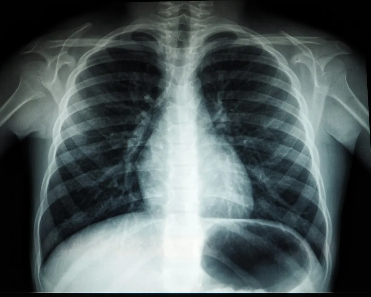 Radiografia de tórax mostrando costelas, pulmões e coração