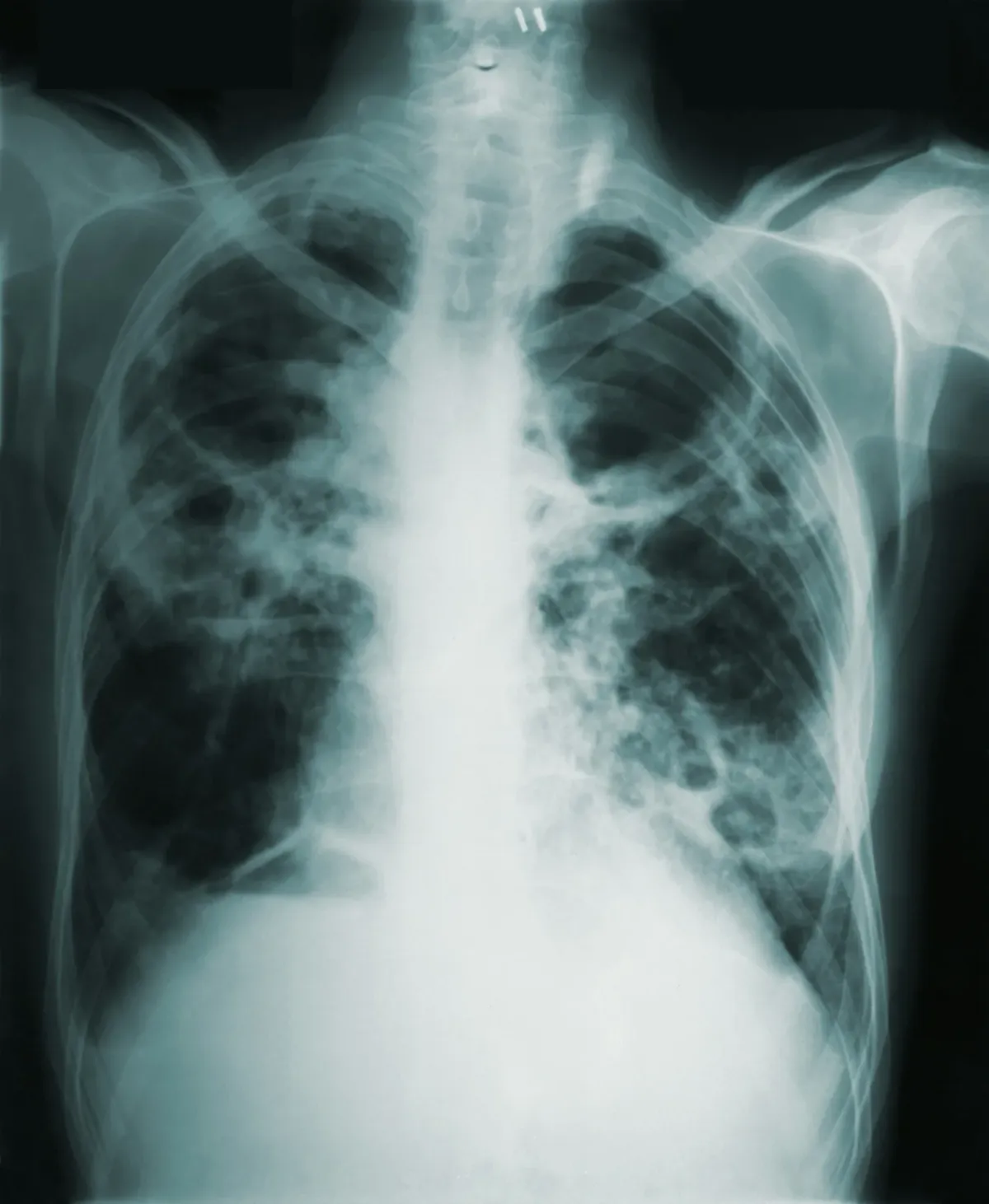 Radiografia de tórax com lesões pulmonares em close