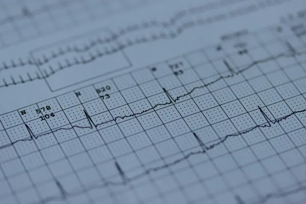 Traçado de eletrocardiograma impresso em papel quadriculado