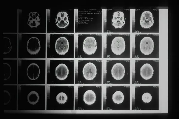 Filme com cortes de ressonância magnética do crânio em negatoscópio