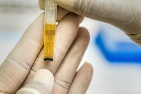 Mão de luva segurando tubo com amostra de urina para exame