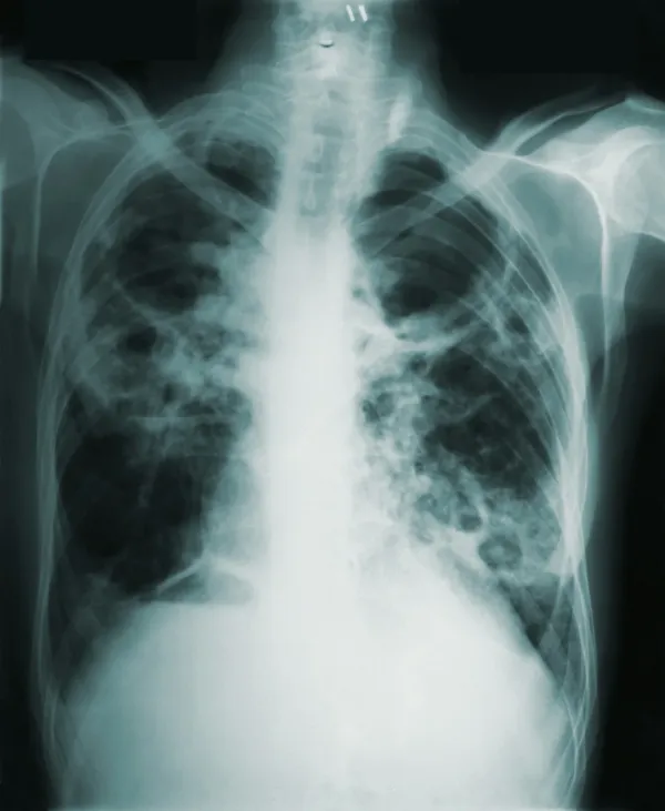 Radiografia de tórax com lesões pulmonares em close